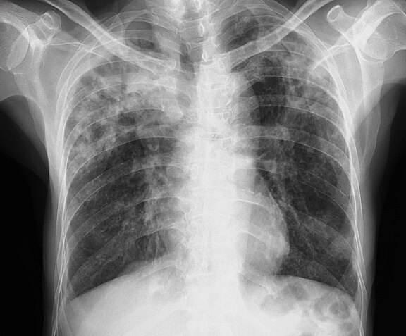 Röntgenbild des Brustkorbs: Vorderansicht mit Rippen, Herz und beiden Lungen. In beiden Lungenfeldern zeigen sich ausgeprägte, wolkig-fleckige Verschattungen, vor allem in den mittleren und unteren Bereichen.