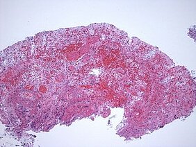 Eine mikroskopische Aufnahme eines Gewebes, hauptsächlich in verschiedenen Rottönen. Die Struktur zeigt eine unregelmäßige, geclusterte Anordnung von Zellen, die zur Analyse histologischer Merkmale verwendet werden kann.