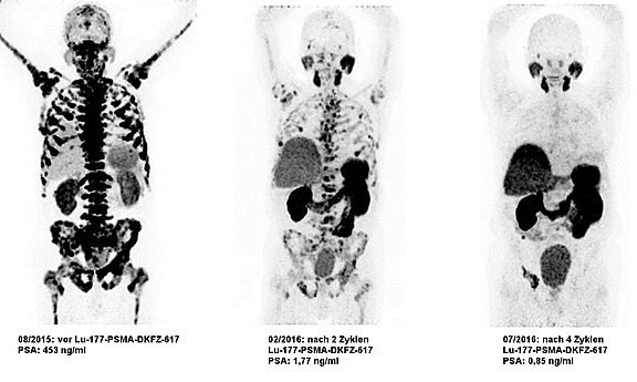 Lutetium-177-PSMA Therapie