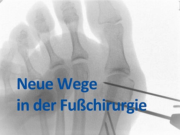 Röntgenbild eines Vorfußes mit sichtbaren Knochen; chirurgische Instrumente zeigen auf den großen Zeh. Überlagert steht der Titel „Neue Wege in der Fußchirurgie“, Hinweis auf innovative Operationsmethoden am Fuß.