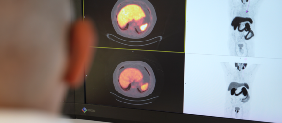 Eine Person betrachtet auf einem Monitor PET/CT-Aufnahmen: zwei Querschnitte des Abdomens mit hellen Aktivitätsbereichen und zwei Ganzkörperbildern. Die Darstellung weist auf mögliche Auffälligkeiten im Bauchraum hin.