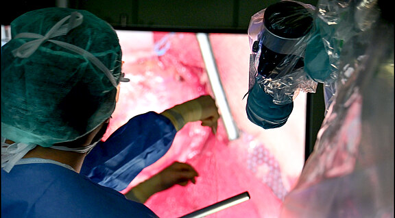 Operationssaal: Ein Chirurg blickt auf einen großen Bildschirm mit Endoskopie-Aufnahme von Gewebe. Mehrere Instrumente arbeiten minimalinvasiv; ein abgedecktes Kamerasystem unterstützt die präzise Führung während des Eingriffs.
