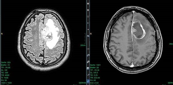 Zwei axiale MRT-Bilder des Gehirns. Links zeigt FLAIR eine ausgedehnte helle Schwellung im rechten Frontallappen. Rechts zeigt T1 mit Kontrast eine ringförmig aufnehmende Läsion mit zentraler Dunkelzone, umgeben von Ödem.