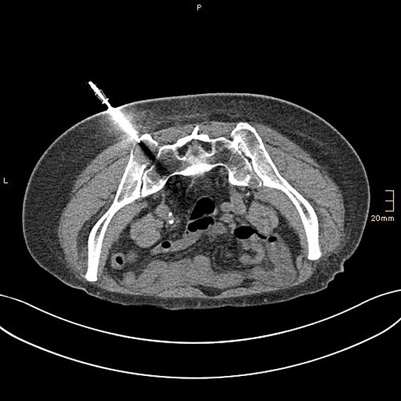 CT-Scan-Bild eines menschlichen Körpers in der Querschnittsansicht. Eine Spritze ist in ein Gewebe eingestochen, um eine medizinische Intervention darzustellen. Darunter sind anatomische Strukturen sichtbar, während der Hintergrund schwarz bleibt.