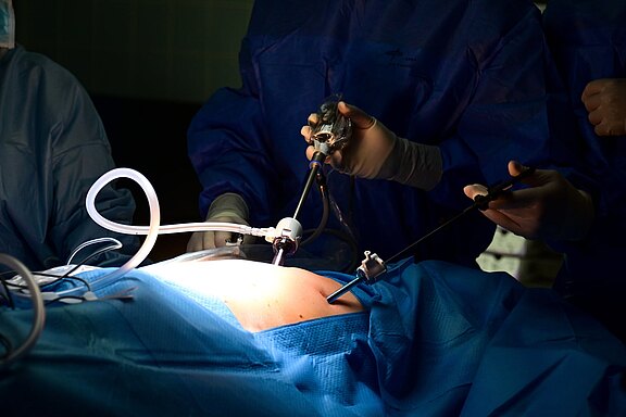 Chirurgen führen eine minimalinvasive, laparoskopische Bauchoperation durch. Durch kleine Schnitte sind Trokare, Kamera und Instrumente eingeführt; ein Schlauch insuffliert Gas. Der Patient liegt abgedeckt unter sterilen OP-Tüchern im Operationssaal.