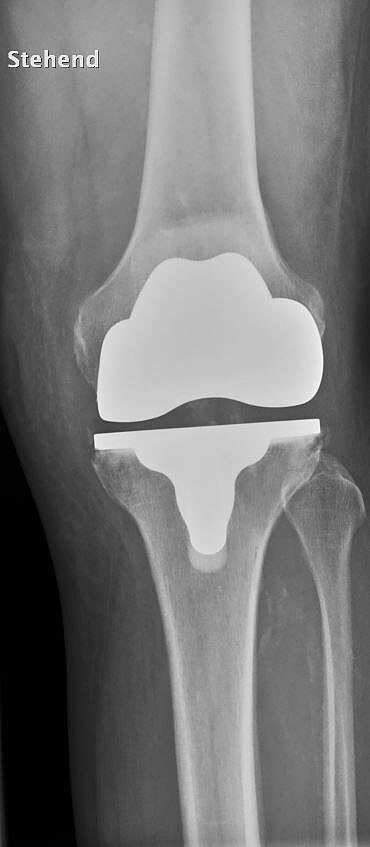 Röntgenbild eines Knies mit eingesetzter Kniegelenkprothese: Metallkomponenten am Oberschenkel- und Schienbeinknochen sowie der Zwischenraum sind deutlich sichtbar; Ausrichtung und Sitz der Prothese im Gelenk erkennbar.