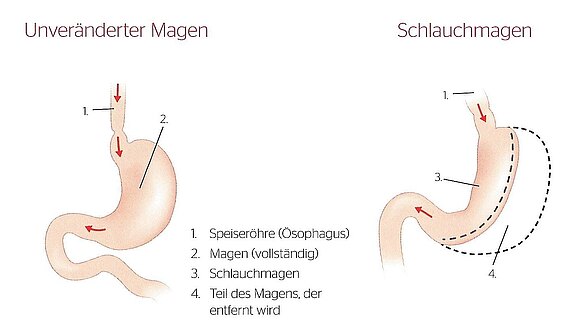 Grafik vergleicht normalen Magen mit Schlauchmagen: Links der unveränderte, beutelartige Magen unter der Speiseröhre. Rechts der chirurgisch verengte, schlauchförmige Magen; der entfernte Anteil ist gestrichelt markiert. Pfeile zeigen den Nahrungsweg.