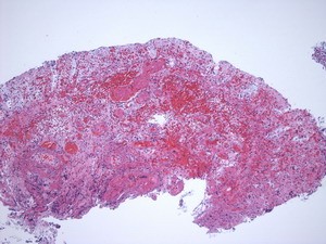 Eine mikroskopische Aufnahme eines Gewebes, hauptsächlich in verschiedenen Rottönen. Die Struktur zeigt eine unregelmäßige, geclusterte Anordnung von Zellen, die zur Analyse histologischer Merkmale verwendet werden kann.